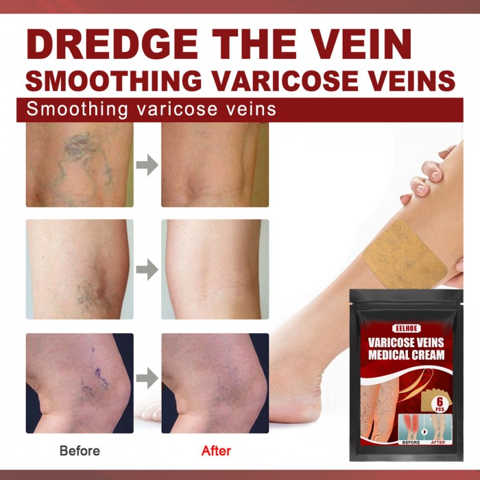 Vein Massage Varicose Plaster (3 boxes of value pack) Vein Massage Pain Relief